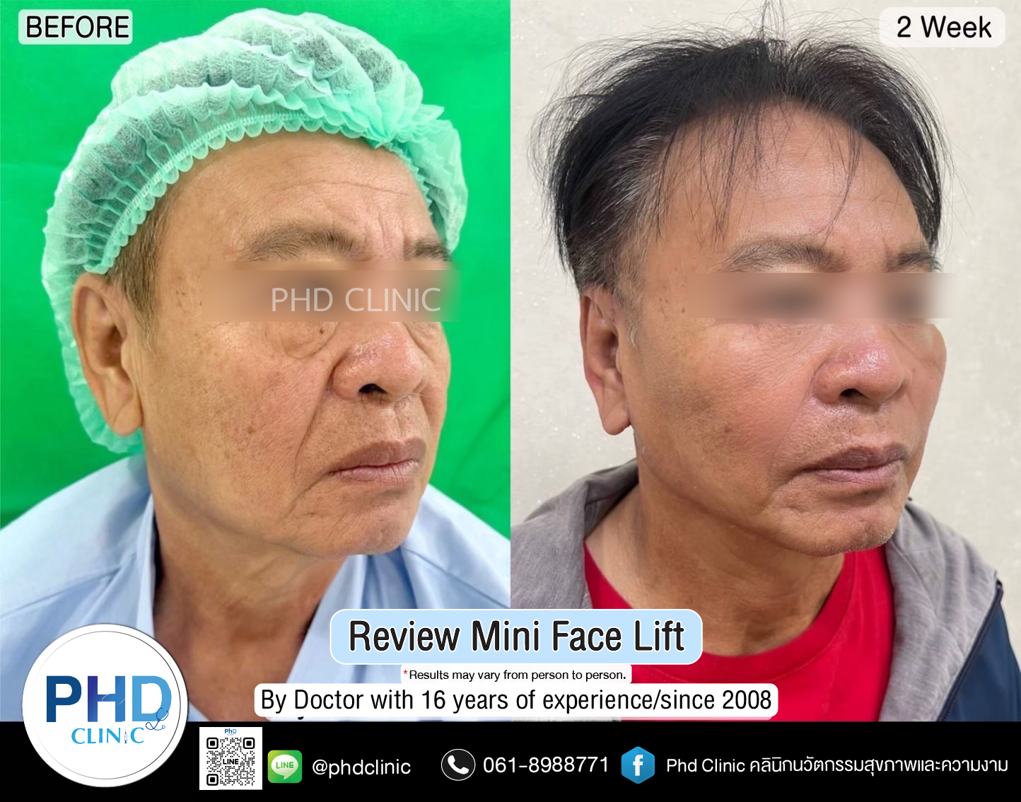 mini face lift