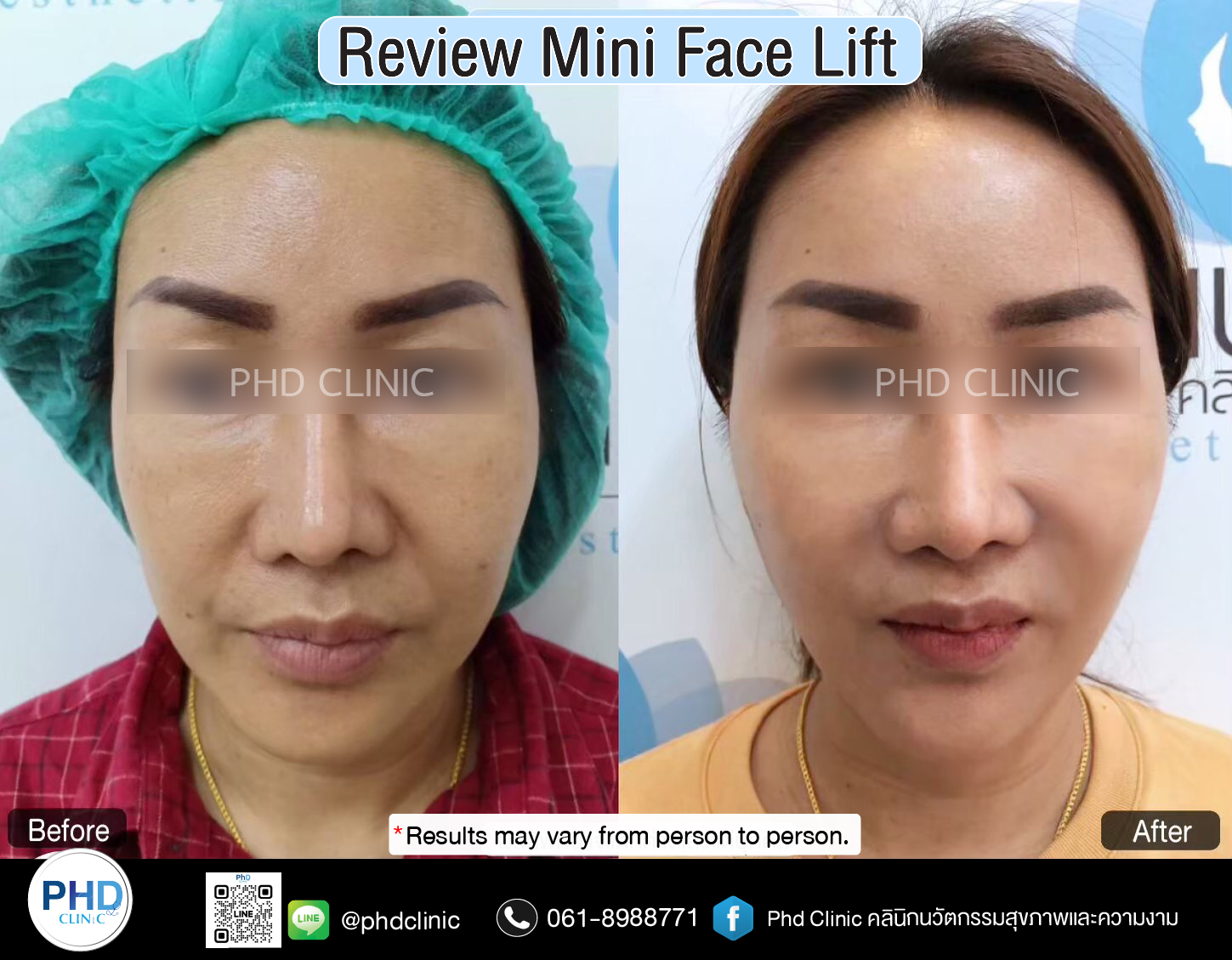 mini face lift