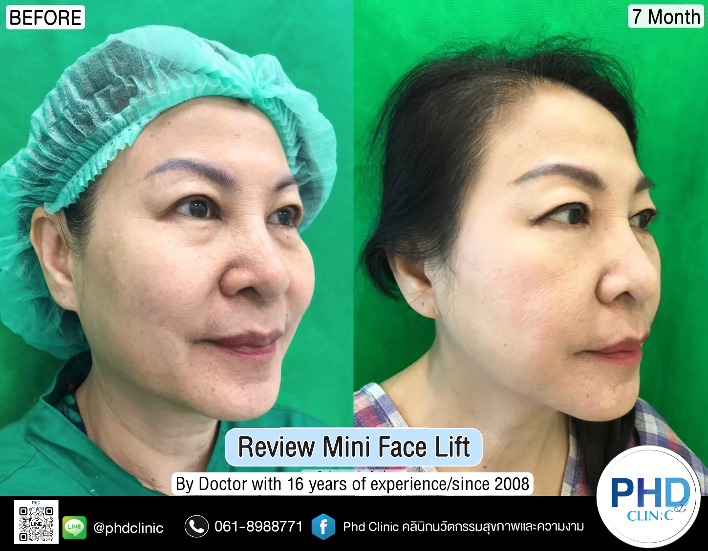 mini face lift