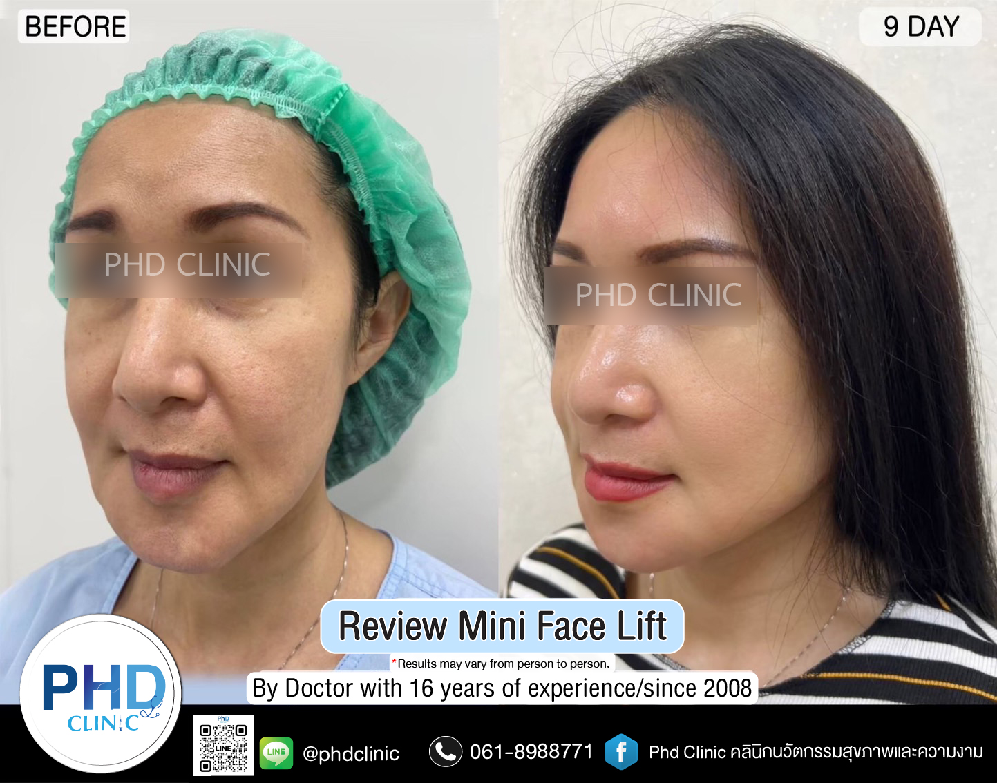 mini face lift