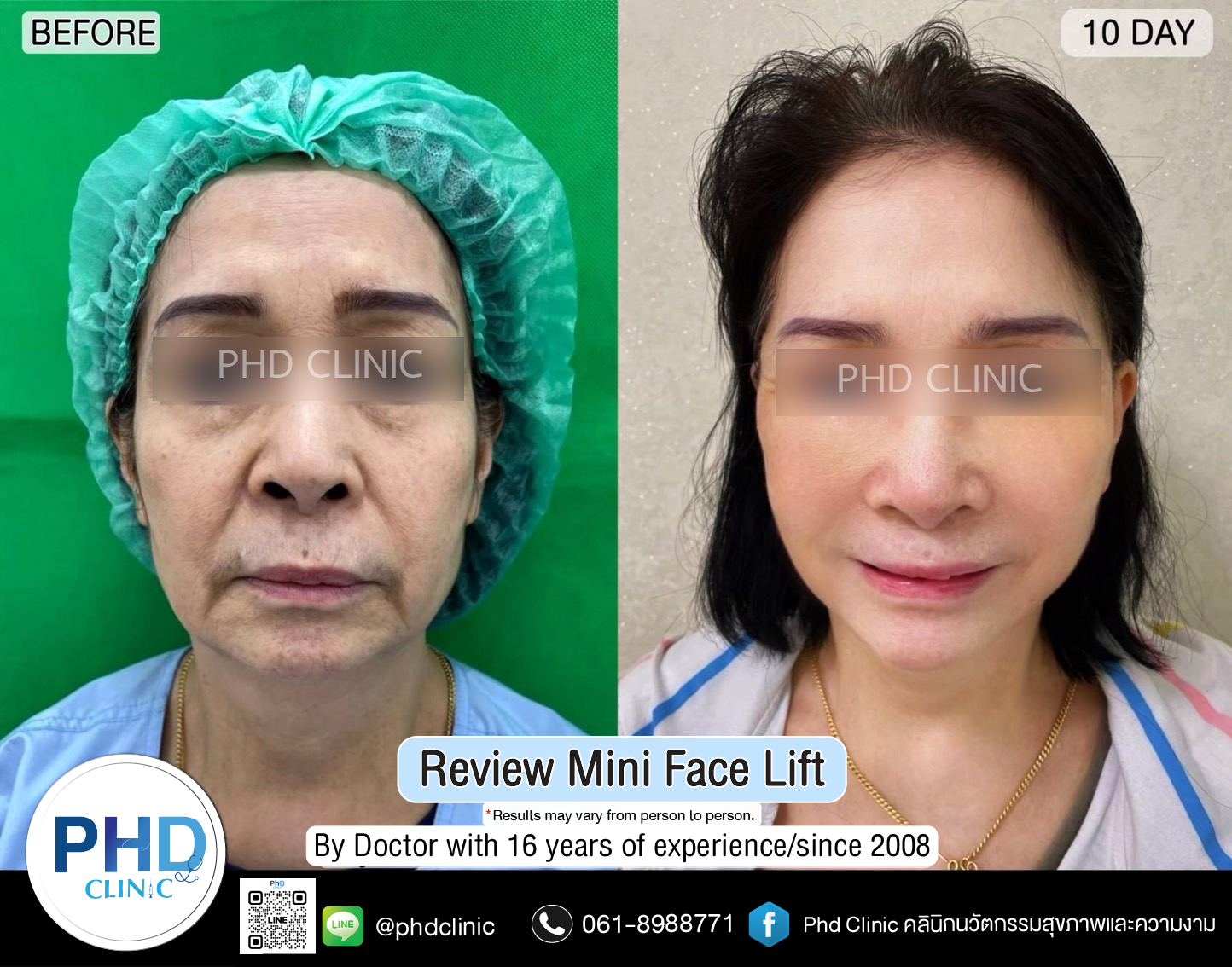 mini face lift