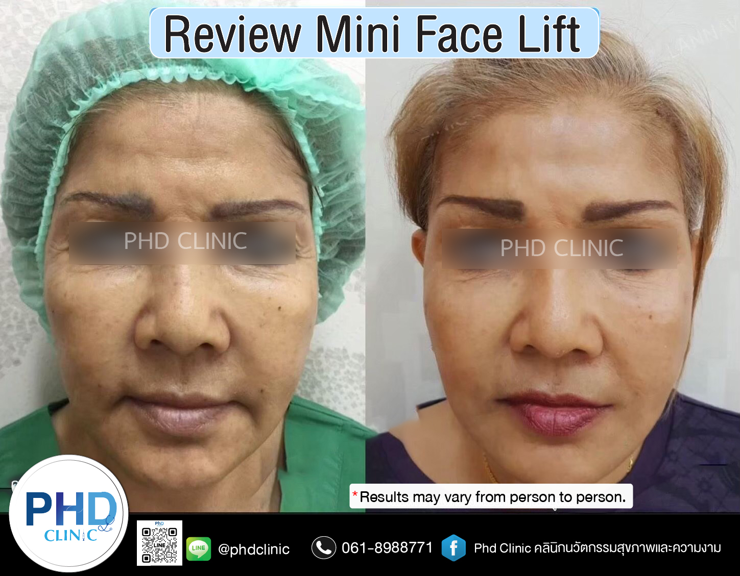 mini face lift