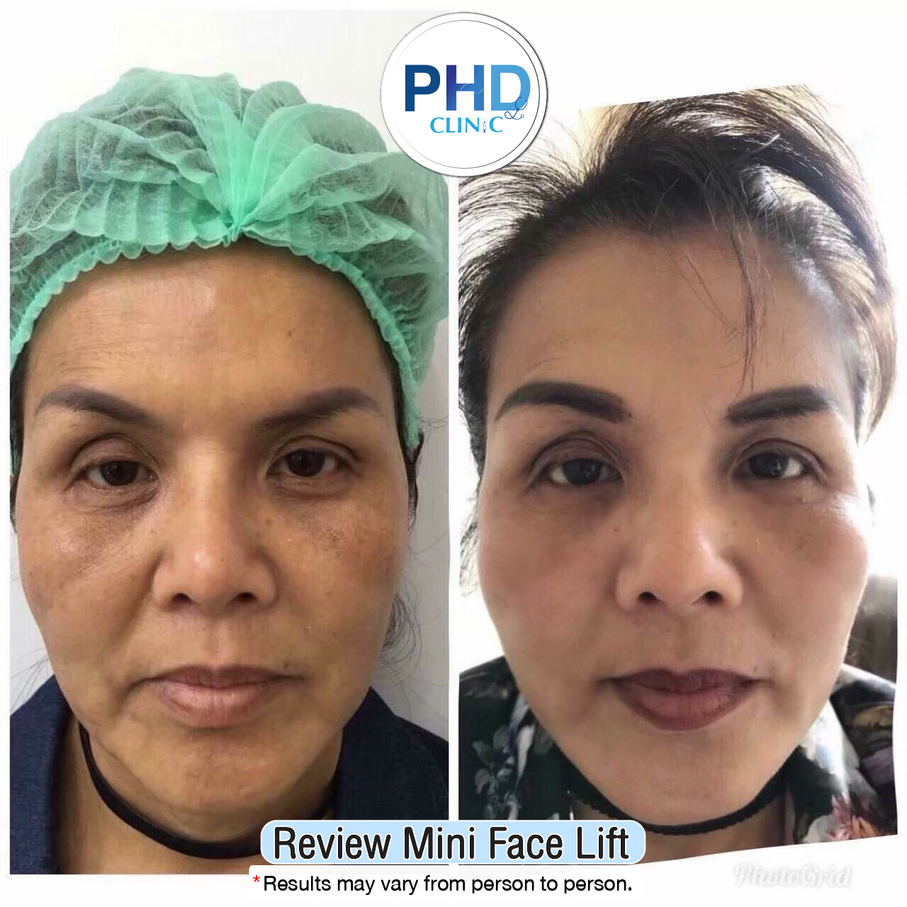 mini face lift